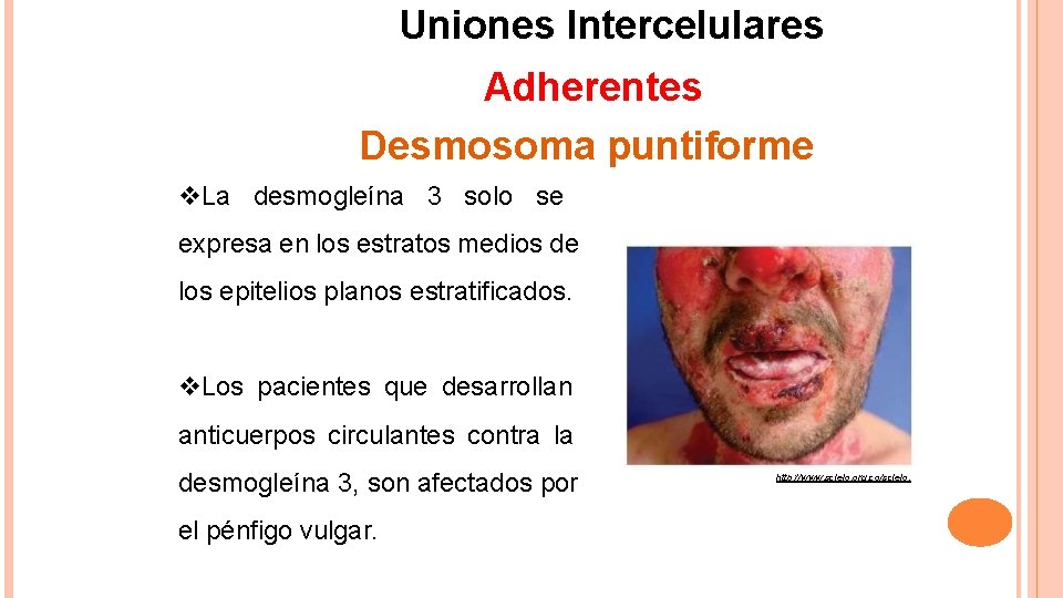 Uniones Intercelulares Adherentes Desmosoma puntiforme La desmogleína 3 solo se expresa en los estratos