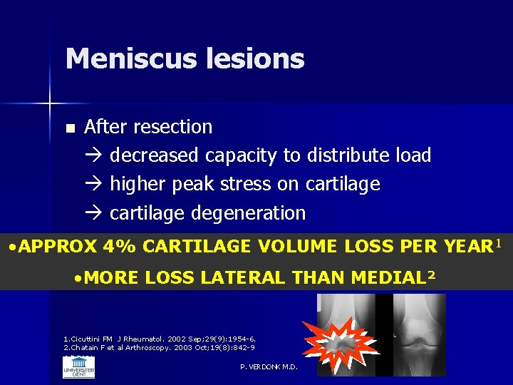 Meniscus lesions n After resection decreased capacity to distribute load higher peak stress on