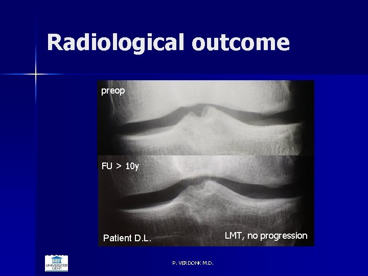 Radiological outcome preop FU > 10 y LMT, no progression Patient D. L. 6/5/2021