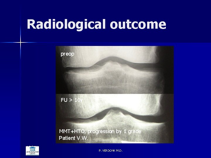 Radiological outcome preop FU > 10 y MMT+HTO, progression by 1 grade Patient V.