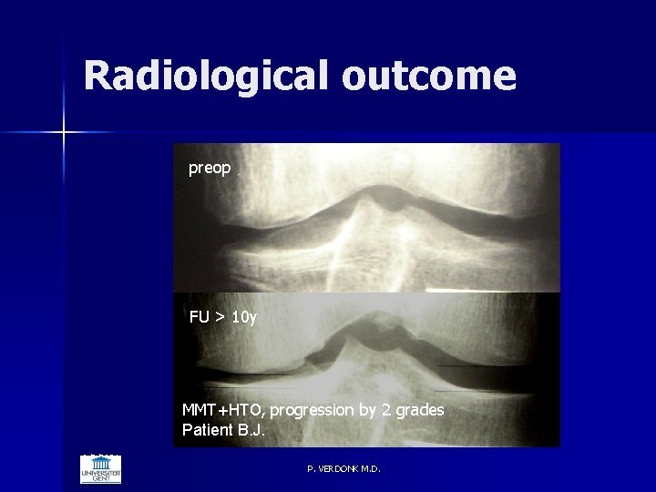 Radiological outcome preop FU > 10 y MMT+HTO, progression by 2 grades Patient B.