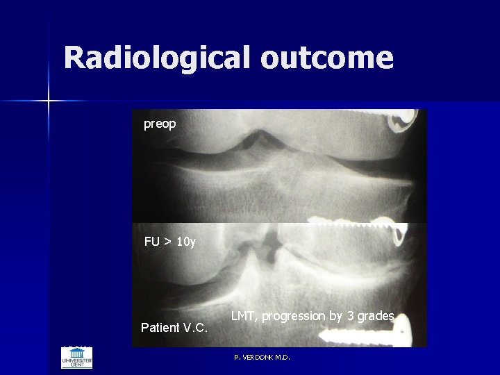 Radiological outcome preop FU > 10 y Patient V. C. 6/5/2021 LMT, progression by