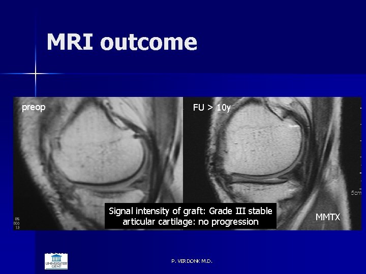 MRI outcome preop FU > 10 y Signal intensity of graft: Grade III stable