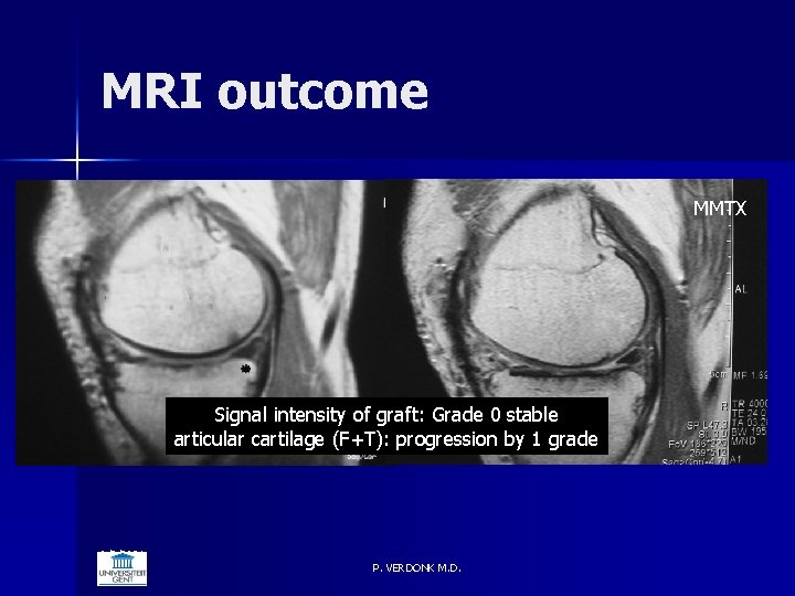 MRI outcome MMTX Signal intensity of graft: Grade 0 stable articular cartilage (F+T): progression