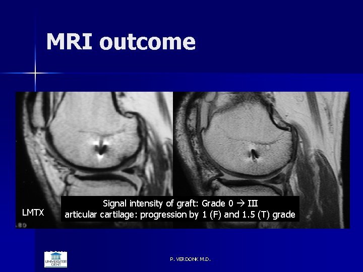 MRI outcome LMTX Signal intensity of graft: Grade 0 III articular cartilage: progression by