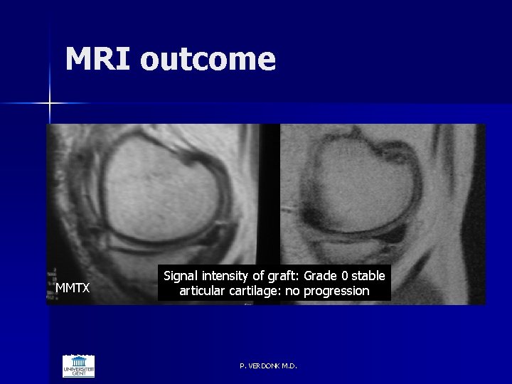 MRI outcome MMTX 6/5/2021 Signal intensity of graft: Grade 0 stable articular cartilage: no