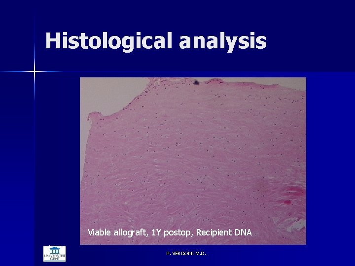 Histological analysis Viable allograft, 1 Y postop, Recipient DNA 6/5/2021 P. VERDONK M. D.