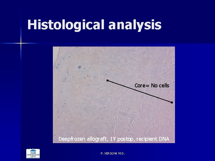 Histological analysis Core= No cells Deepfrozen allograft, 1 Y postop, recipient DNA 6/5/2021 P.