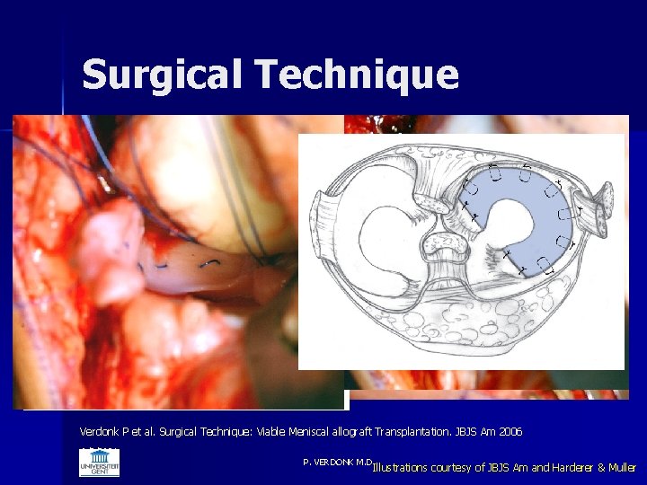 Surgical Technique Verdonk P et al. Surgical Technique: Viable Meniscal allograft Transplantation. JBJS Am