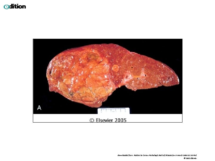 Downloaded from: Robbins & Cotran Pathologic Basis of Disease (on 9 March 2006 02: