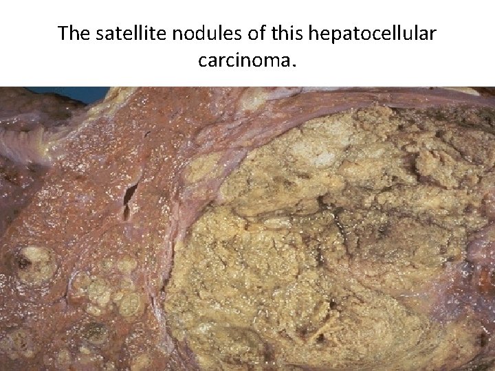 The satellite nodules of this hepatocellular carcinoma. 