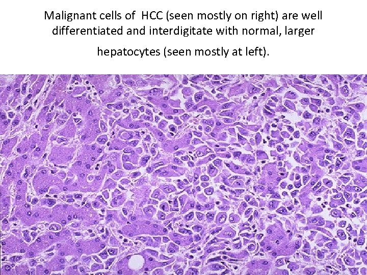 Malignant cells of HCC (seen mostly on right) are well differentiated and interdigitate with