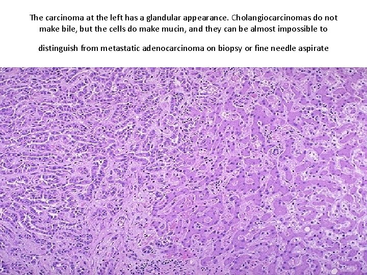 The carcinoma at the left has a glandular appearance. Cholangiocarcinomas do not make bile,