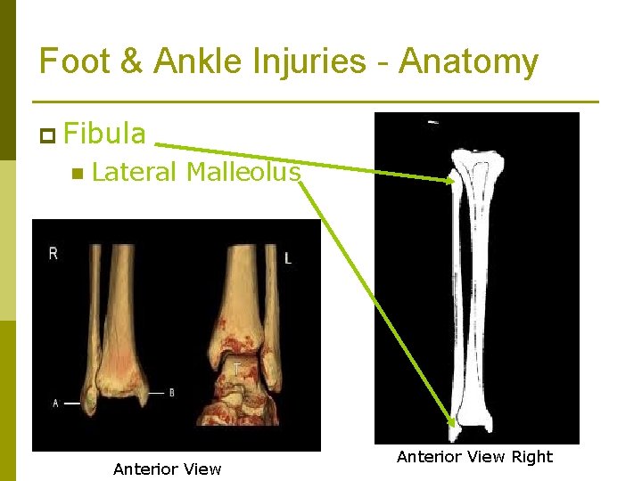 Foot & Ankle Injuries - Anatomy p Fibula n Lateral Malleolus Anterior View Right