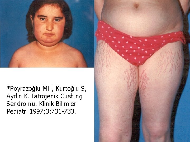 *Poyrazoğlu MH, Kurtoğlu S, Aydın K. İatrojenik Cushing Sendromu. Klinik Bilimler Pediatri 1997; 3: