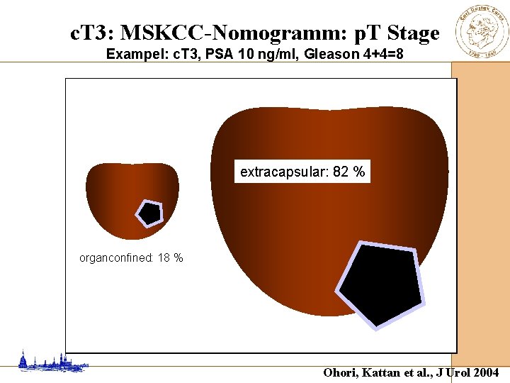 c. T 3: MSKCC-Nomogramm: p. T Stage Exampel: c. T 3, PSA 10 ng/ml,