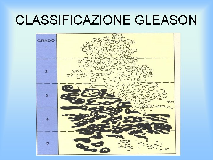 CLASSIFICAZIONE GLEASON 