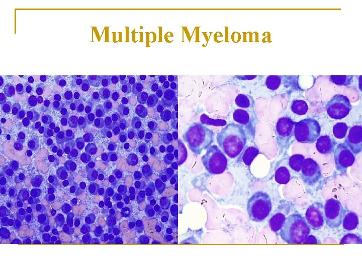 Multiple Myeloma 
