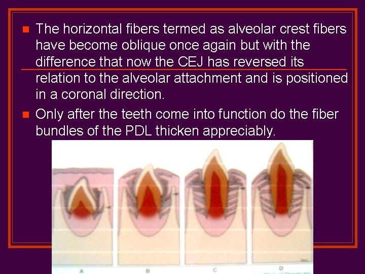 n n The horizontal fibers termed as alveolar crest fibers have become oblique once