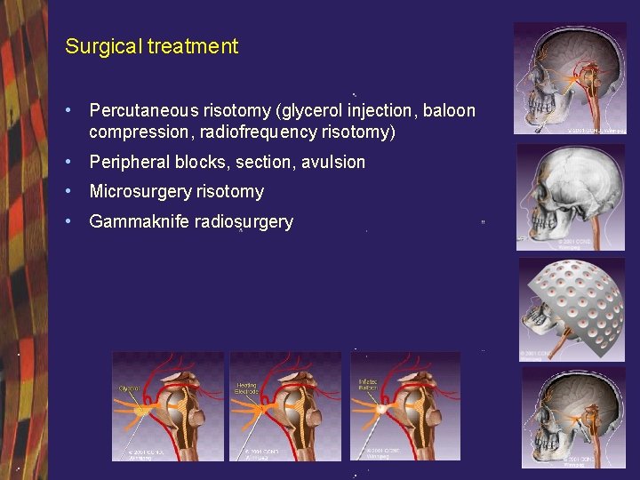Surgical treatment • Percutaneous risotomy (glycerol injection, baloon compression, radiofrequency risotomy) • Peripheral blocks,