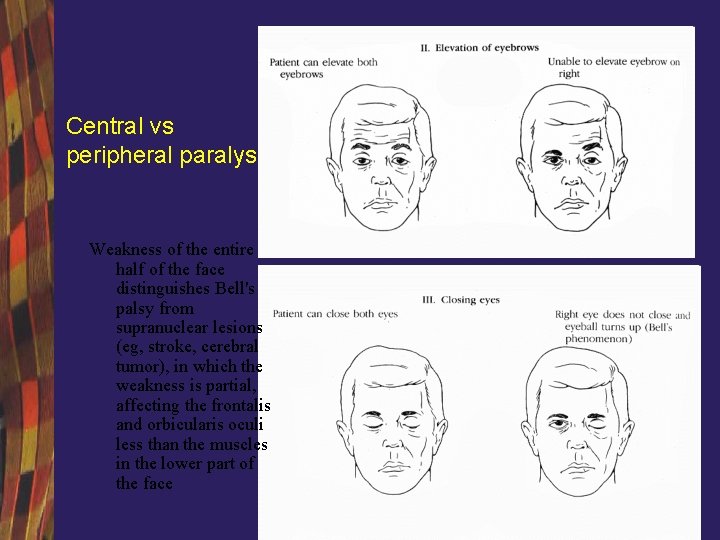 Central vs peripheral paralysis Weakness of the entire half of the face distinguishes Bell's