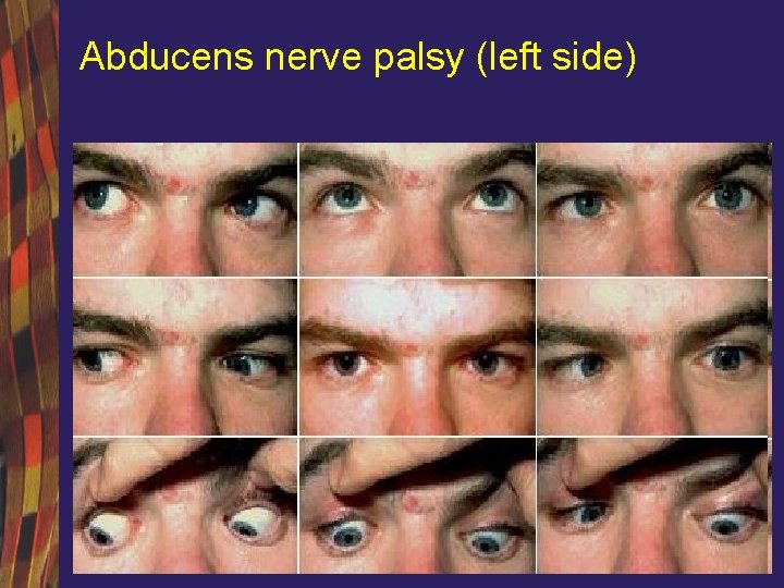 Abducens nerve palsy (left side) 
