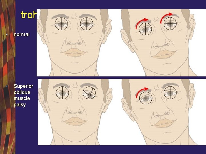 trohlear • normal • Superior oblique muscle palsy 