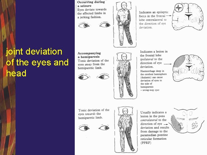 joint deviation of the eyes and head 