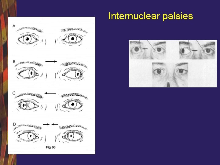 Internuclear palsies 