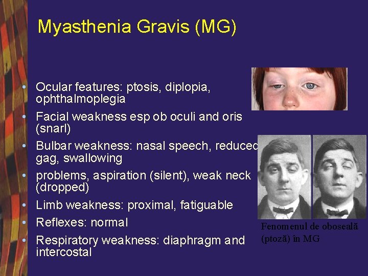Myasthenia Gravis (MG) • Ocular features: ptosis, diplopia, ophthalmoplegia • Facial weakness esp ob