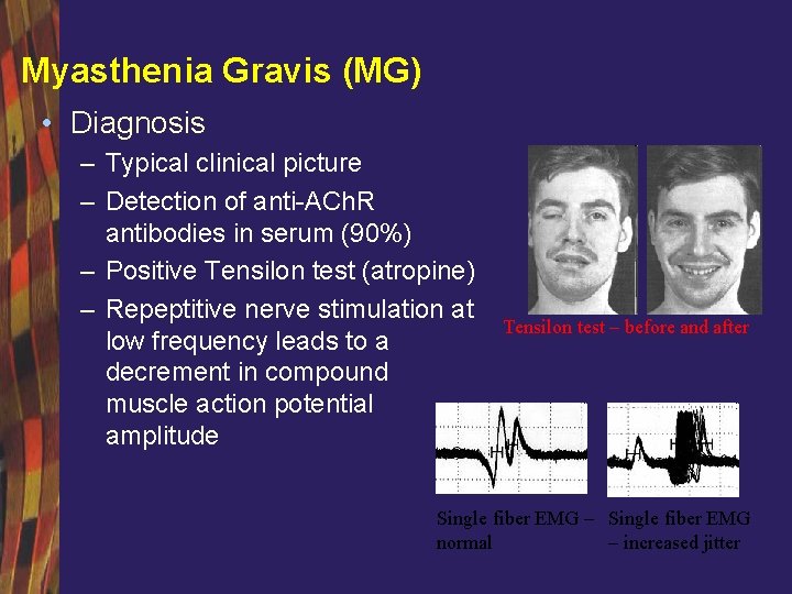 Myasthenia Gravis (MG) • Diagnosis – Typical clinical picture – Detection of anti-ACh. R