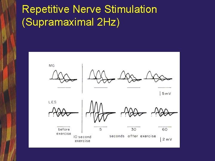 Repetitive Nerve Stimulation (Supramaximal 2 Hz) 