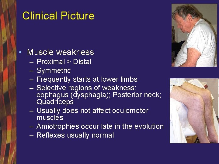 Clinical Picture • Muscle weakness – – Proximal > Distal Symmetric Frequently starts at