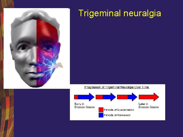 Trigeminal neuralgia 