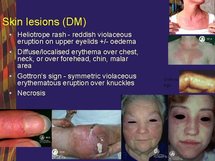 Skin lesions (DM) • Heliotrope rash - reddish violaceous eruption on upper eyelids +/-