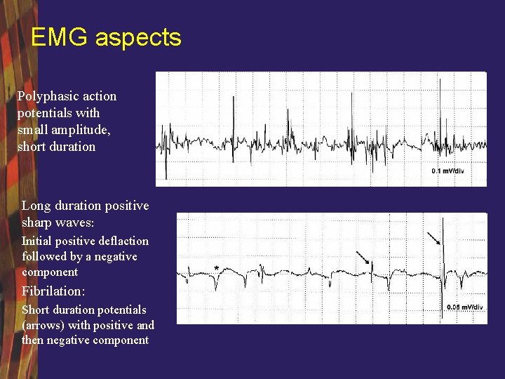 EMG aspects Polyphasic action potentials with small amplitude, short duration Long duration positive sharp