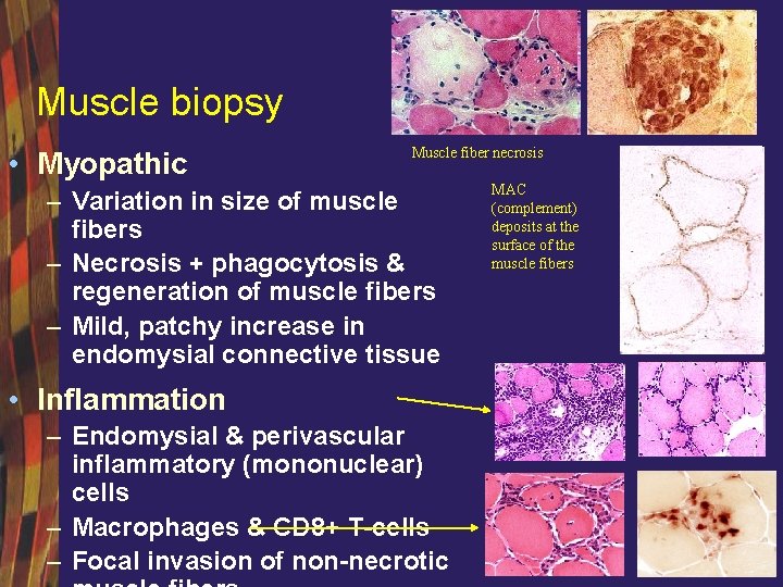 Muscle biopsy • Myopathic Muscle fiber necrosis – Variation in size of muscle fibers