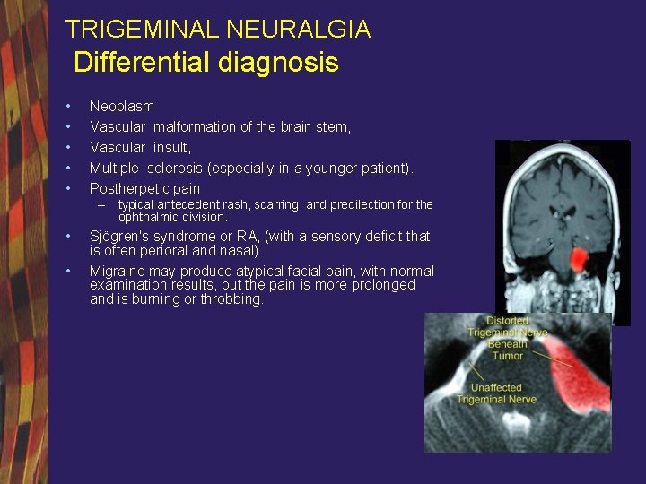 TRIGEMINAL NEURALGIA Differential diagnosis • • • Neoplasm Vascular malformation of the brain stem,