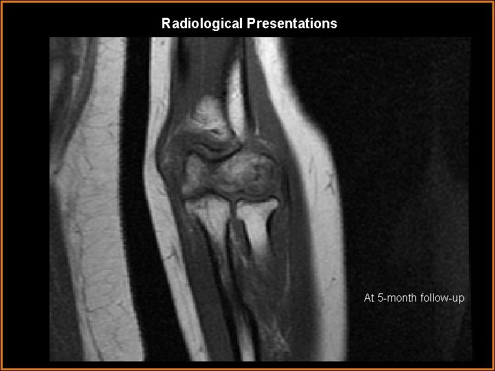 Radiological Presentations At 5 -month follow-up 