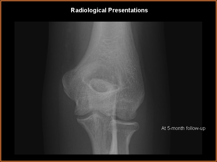 Radiological Presentations At 5 -month follow-up 