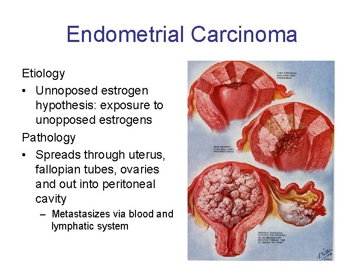 Endometrial Carcinoma Etiology • Unnoposed estrogen hypothesis: exposure to unopposed estrogens Pathology • Spreads