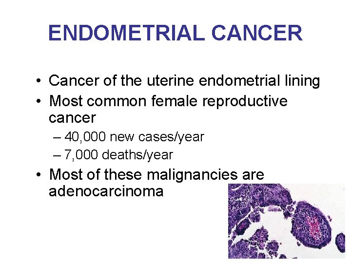 ENDOMETRIAL CANCER • Cancer of the uterine endometrial lining • Most common female reproductive