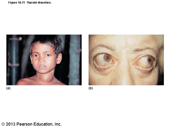 Figure 16. 11 Thyroid disorders. © 2013 Pearson Education, Inc. 