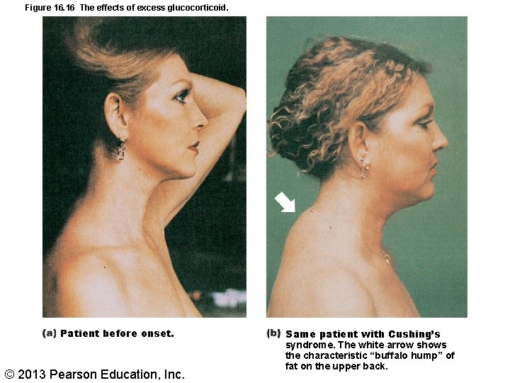Figure 16. 16 The effects of excess glucocorticoid. Patient before onset. © 2013 Pearson