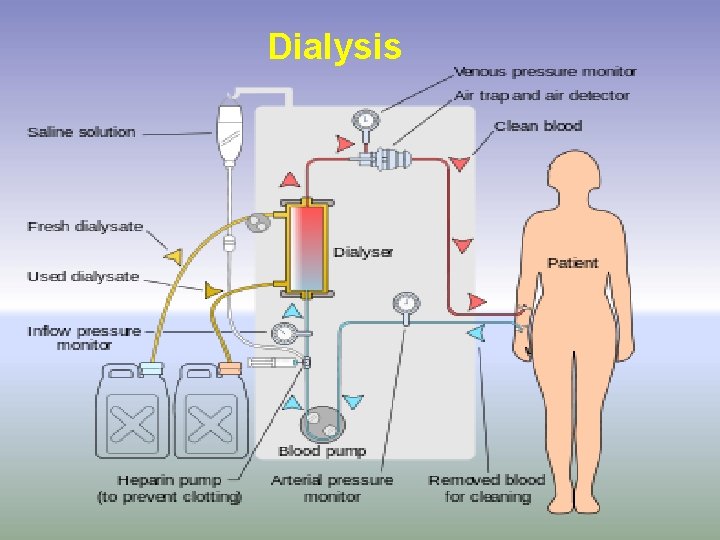 Dialysis 