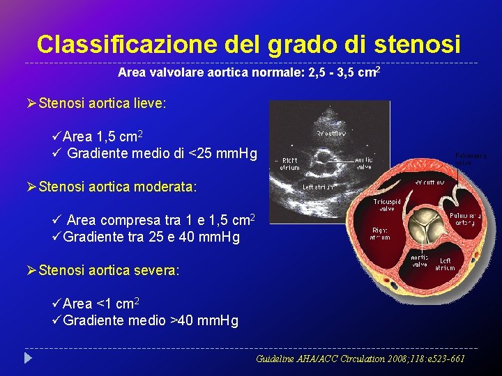 Classificazione del grado di stenosi Area valvolare aortica normale: 2, 5 - 3, 5