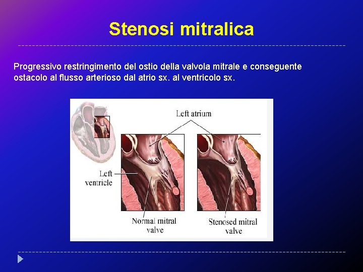 Stenosi mitralica Progressivo restringimento del ostio della valvola mitrale e conseguente ostacolo al flusso