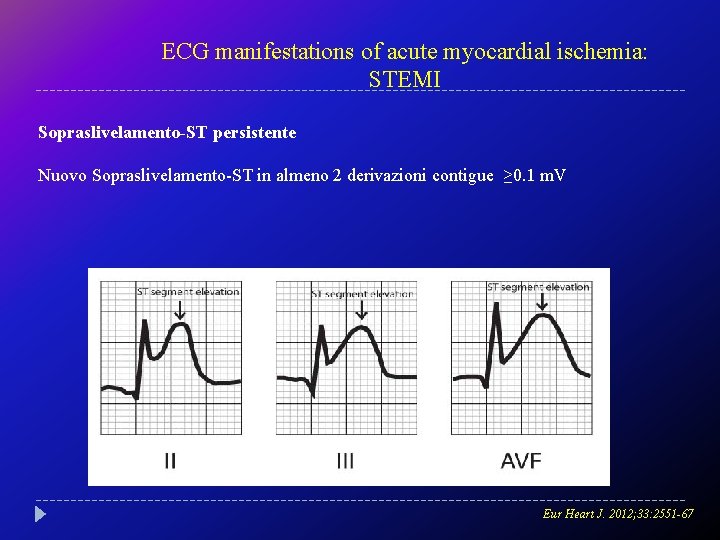 ECG manifestations of acute myocardial ischemia: STEMI Sopraslivelamento-ST persistente Nuovo Sopraslivelamento-ST in almeno 2