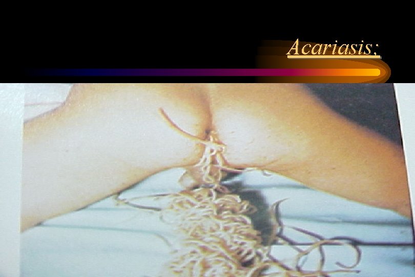 Acariasis; Acariasis;