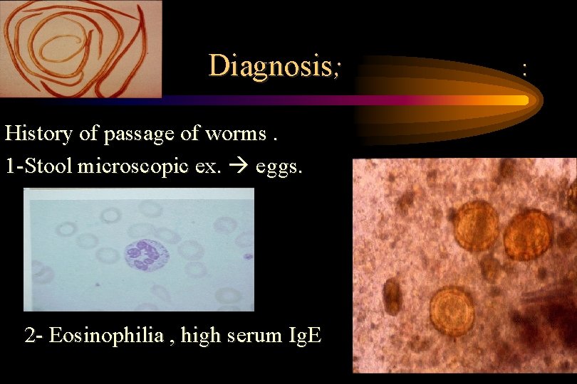 Diagnosis; : History of passage of worms. 1 -Stool microscopic ex. eggs. -2 - Diagnosis; : History of passage of worms. 1 -Stool microscopic ex. eggs. -2 -